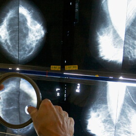 FILE - A radiologist uses a magnifying glass to check mammograms for breast cancer in Los Angeles, May 6, 2010. (AP Photo/Damian Dovarganes, File)