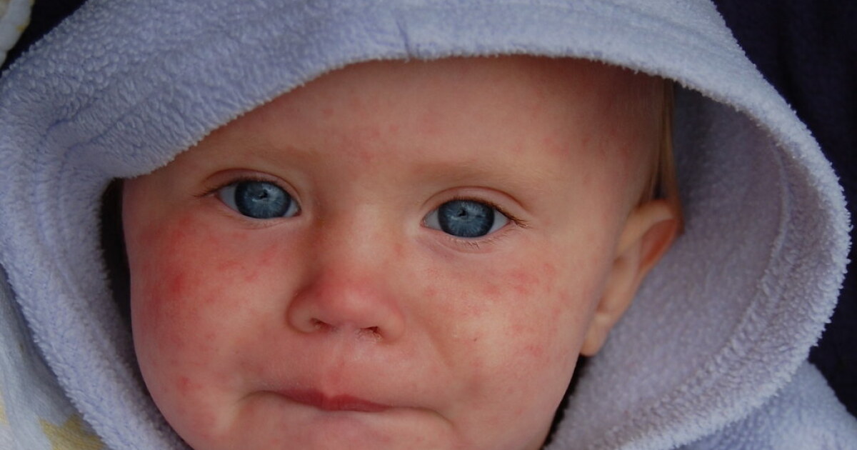 Vaccine change may bring largest measles outbreak ever