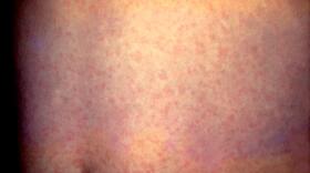 Measles on abdomen