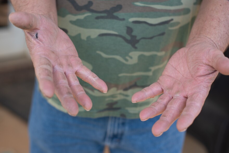 Rily Hughlett shows his calloused hands from years of working in coal mines. Brookwood, Alabama. March 23, 2022.