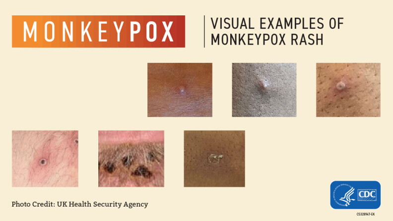 Visual examples of Monkeypox.