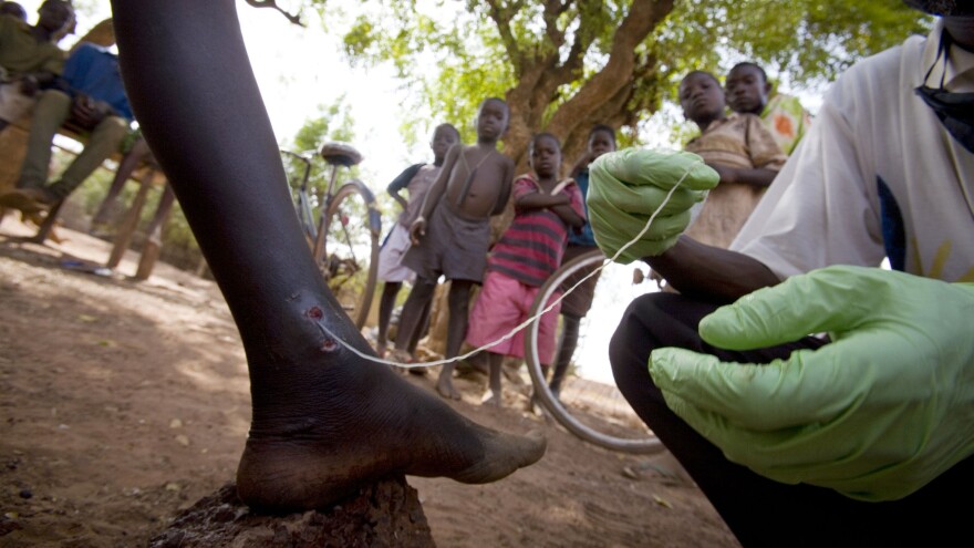 A medical worker extracts a Guinea worm from a child's leg in northern Ghana, February 2007.