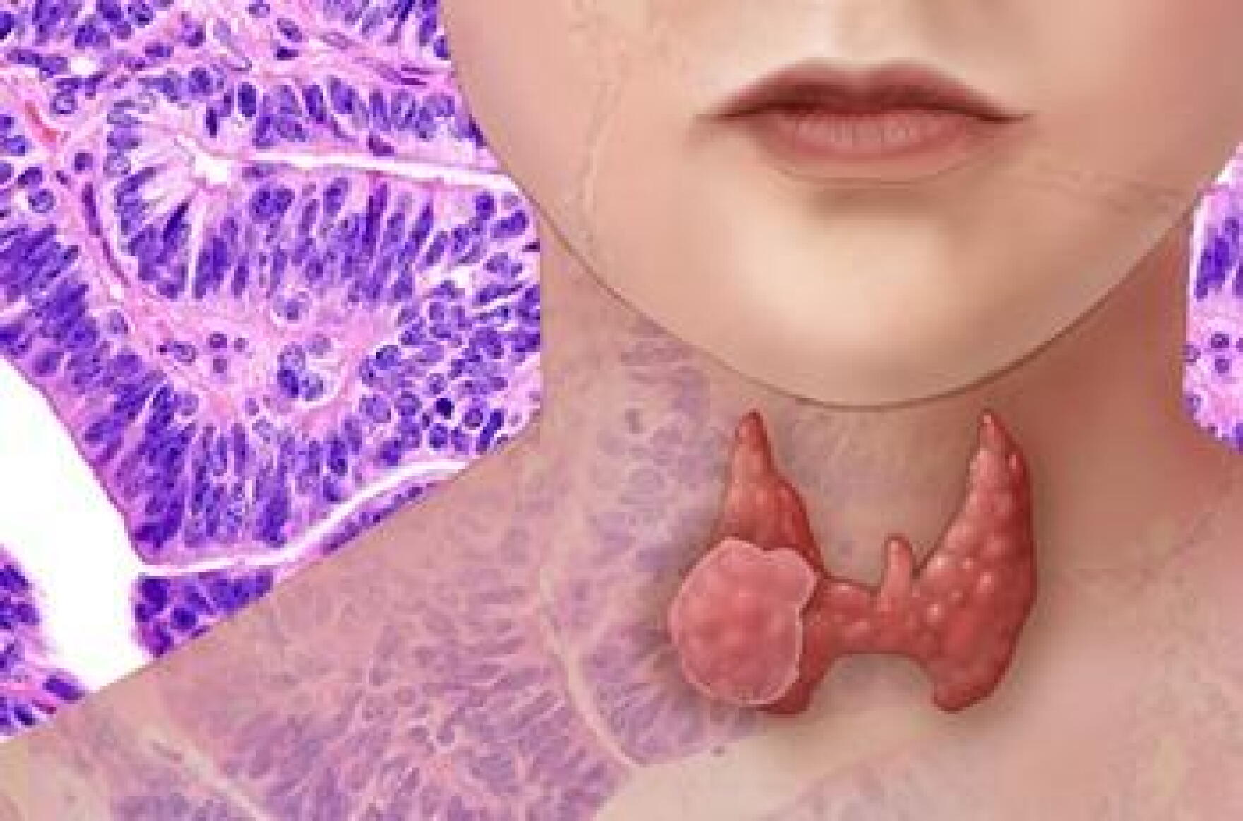Thyroid Cancer Genome Analysis Finds Markers Of Aggressive Tumors