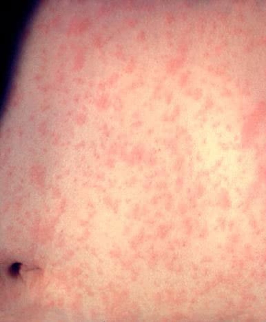 Skin of a patient after three days with measles rash