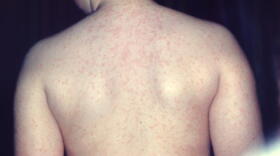 This photograph depicts a posterior view of a young patient’s back, highlighting an erythematous rash associated with measles.