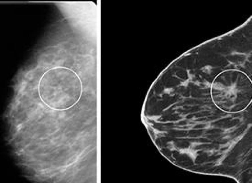 At left, a tumor viewed on standard mammography. At right, the same tumor viewed on the 3D imaging system.