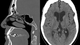 San Antonio researchers are working to uncover traumatic brain injuries in veterans through AI analysis of speech patterns.