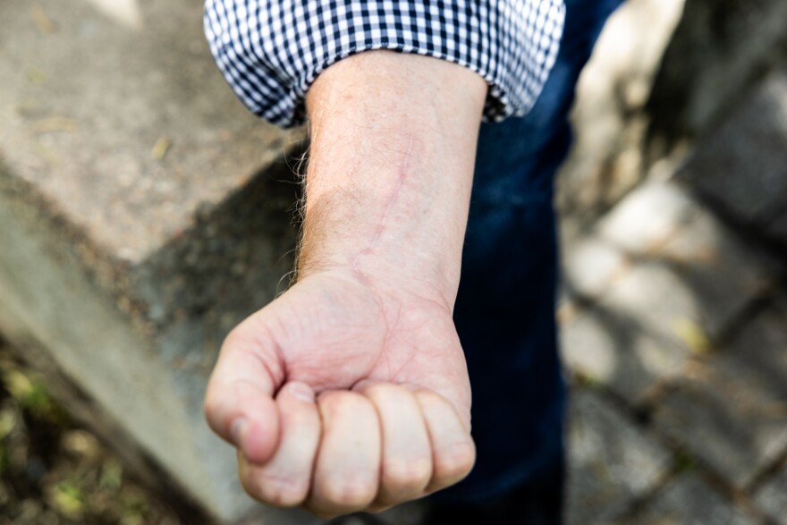 Jeff Hahn displays a scar from his Big Bend ordeal. Hahn broke his wrist while lost for 27 hours in the park.