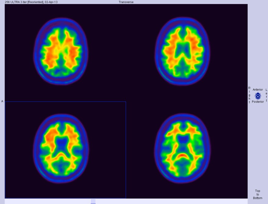 Alzheimer's disease afflicts six percent of people over age sixty five