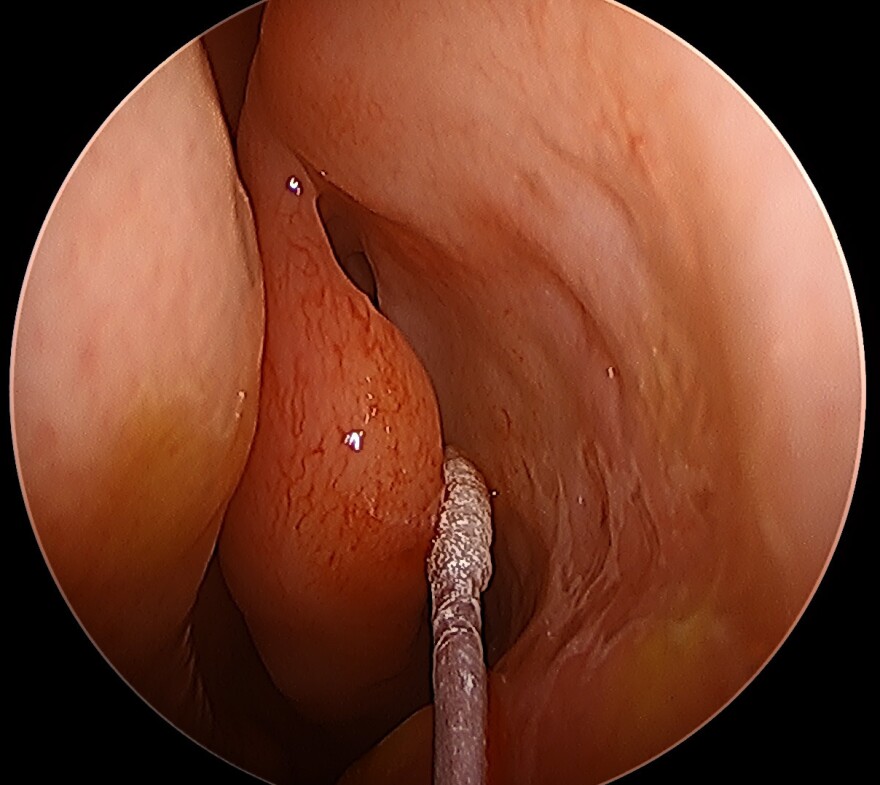 A trip inside the left nostril, with the middle meatus to the left of the collection swab.