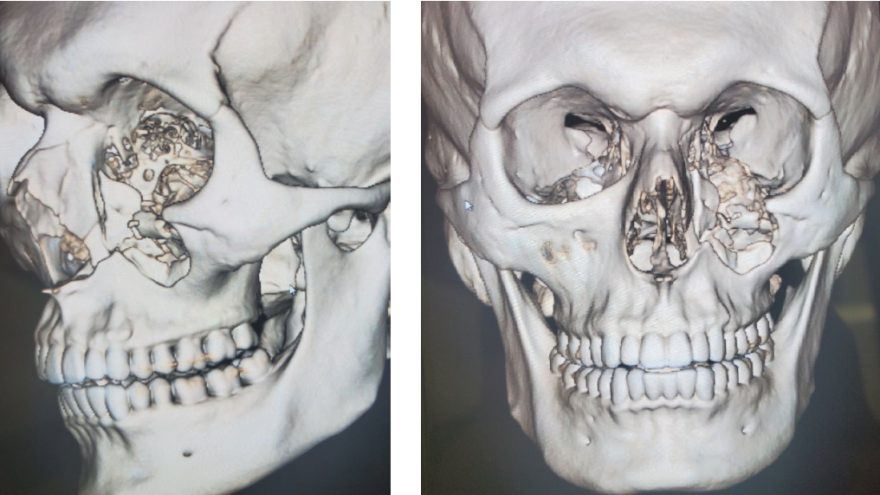 A scan of Sam Kirsch's head shows injuries he sustained after being shot with "less-lethal" ammunition at a protest in May 2020. Kirsch has been left with permanent disabilities.