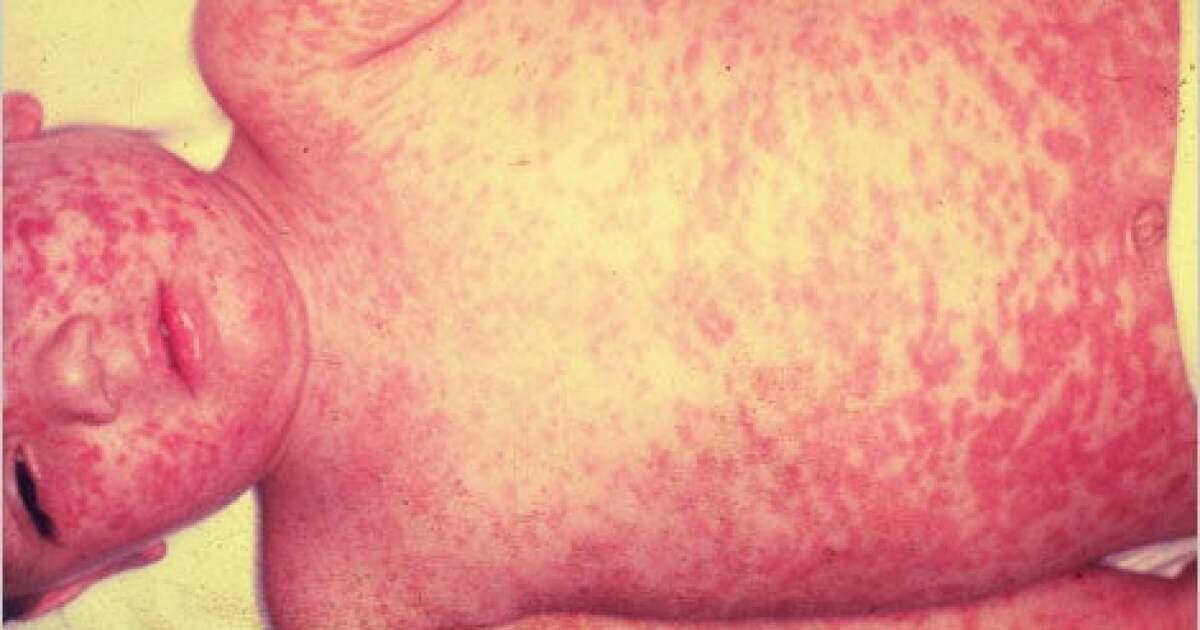 Ave Maria clinic numbers reflect slowing of measles cases, last positive case was Monday; vaccination recommended