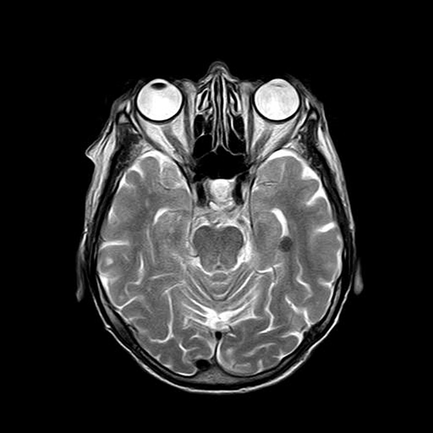 Skull MRI