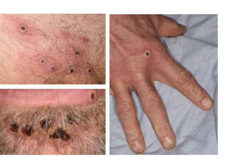 Examples of monkeypox lesions.