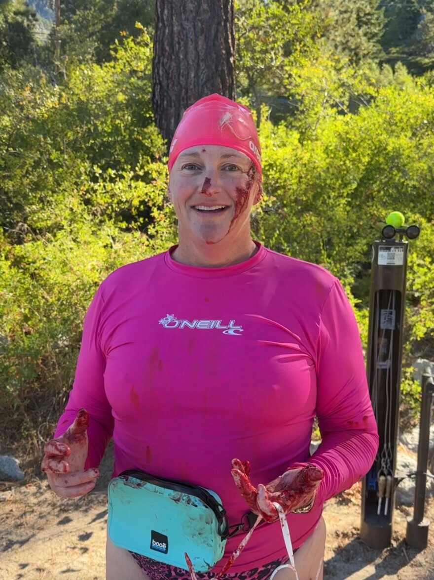 Photo of Lynnette Bellin taken after the otter attack. Bellin has cuts on her nose and cheek and wounds on her fingers.