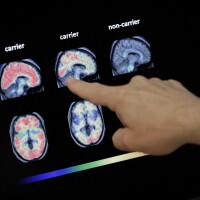 Dr. William Burke goes over a PET brain scan in 2018 at Banner Alzheimers Institute in Phoenix. The drug company Biogen Inc. has received federal approval for a medicine to treat early Alzheimer's disease.