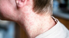 Teenager covered in measles rash.