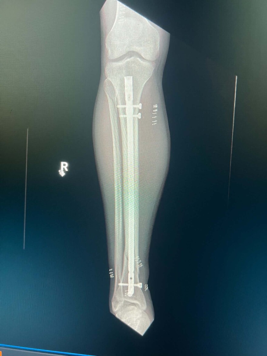 An X-ray shows a rod and screws in Heins’ leg after surgery. He underwent same-day surgery after colliding with a skier on Snowmass Ski Area in February.