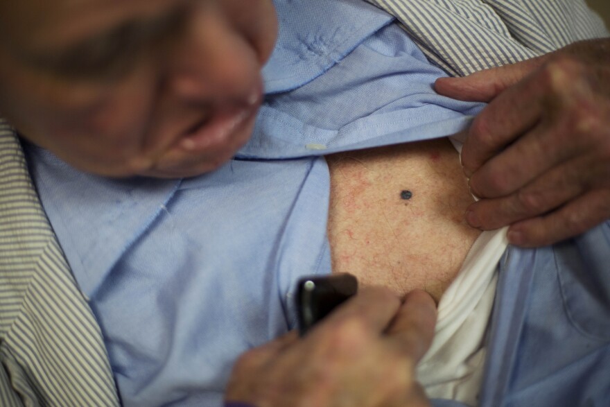 In this photo taken Aug. 27, 2015, John Jay Hooker shows a melanoma spot that has shrunk since starting treatment at Tennessee Oncology in Nashville, Tenn. (AP Photo/David Goldman)