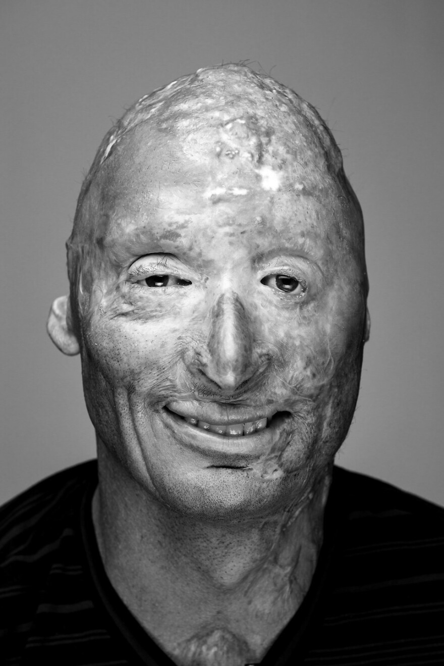 Bobby Henline poses for a portrait. He was injured in Iraq.