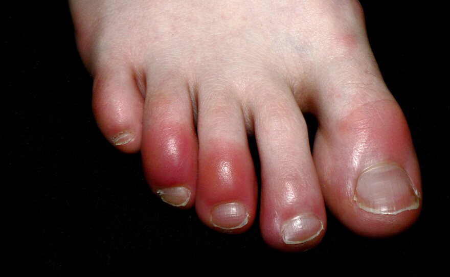Chilblains (pictured) are itchy, red, pink or purple inflammations of the skin's small blood vessels that can develop in body parts such as toes and fingers from exposure to colder temperatures or wet conditions. A similar-looking inflammation of the toes is an emerging symptom of COVID-19 and is being referred to as "COVID toes."