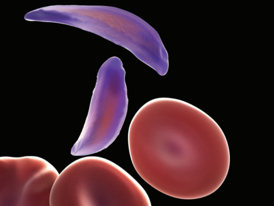 Sickle Cell Rbc Shape Sickle Cell Anemia Is On The Rise Worldwide | KUCB
