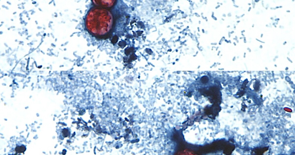 11 cases of cyclospora parasitic infection confirmed in Alabama