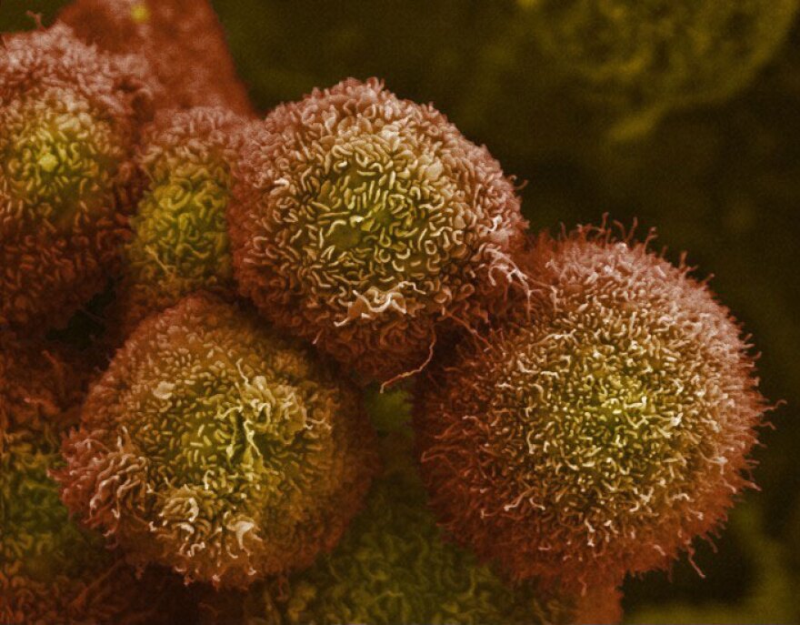 Pancreatic Cancer Why You Should No Longer Think It S A Death Sentence Kera News