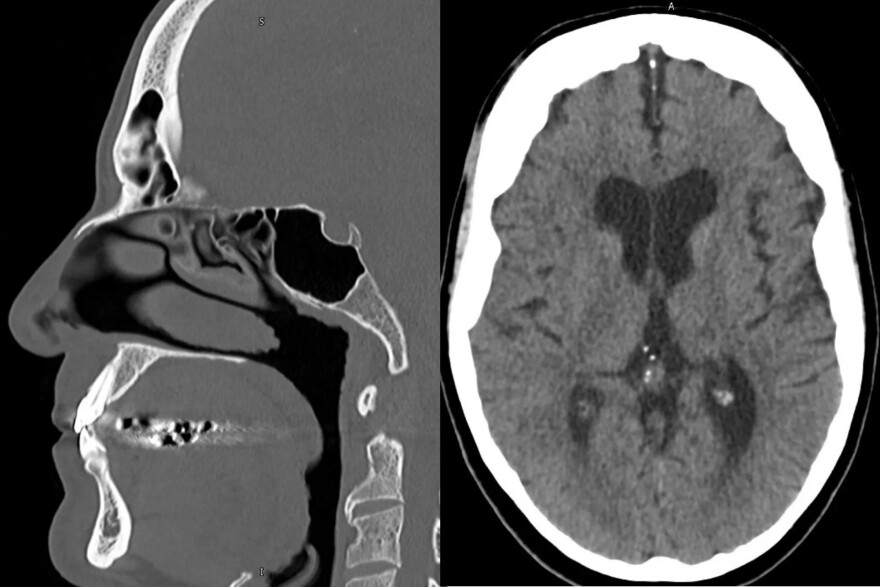 San Antonio researchers are working to uncover traumatic brain injuries in veterans through AI analysis of speech patterns.
