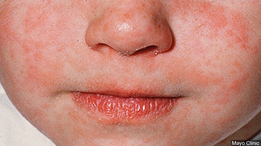 Child with measles rash