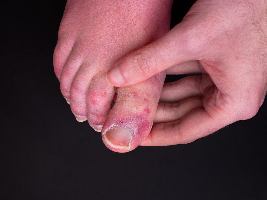 Covid Toe Blood Clots And More Possible Symptoms Of Covid 19 Kera News