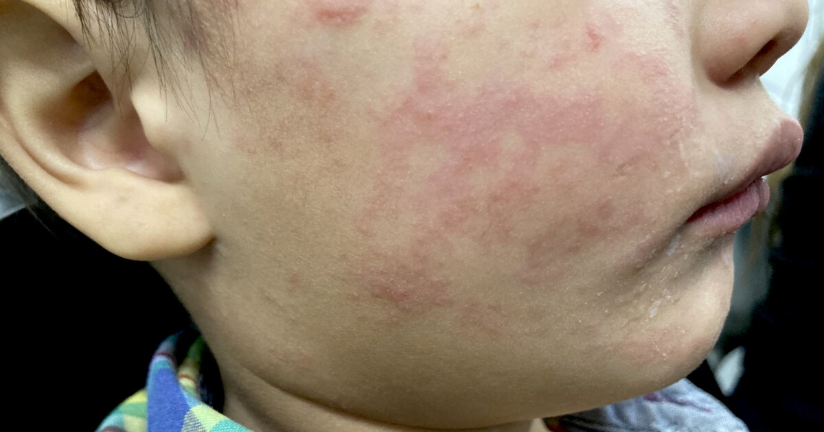 Health officials warn spring break travelers about rise in measles