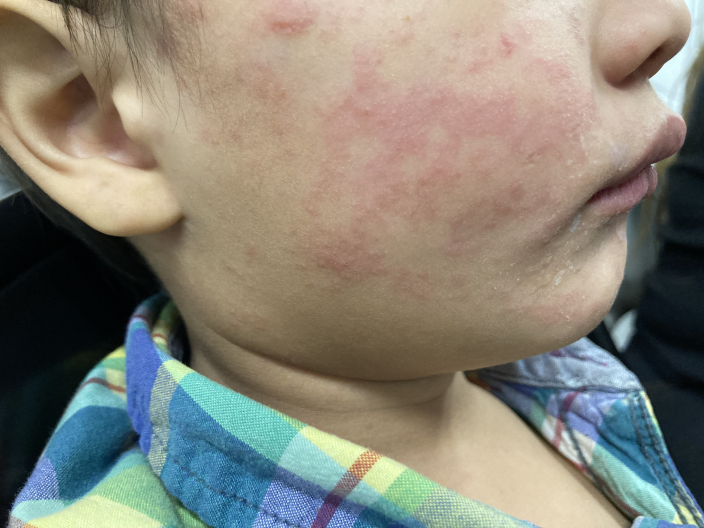 This photograph depicts a child who was infected with measles during an outbreak in the U.S. in 2024. The child’s cheek shows the characteristic rash associated with this viral infection.