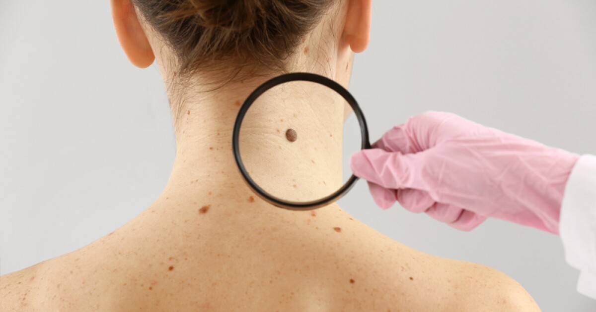 Skin cancer is easier to avoid, but better treatment for those who do get it
