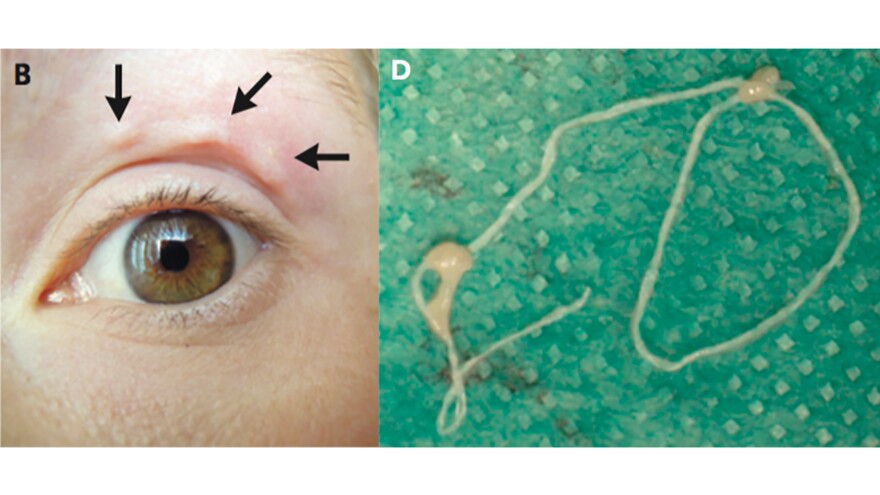 The New England Journal Of Medicine used selfies in a paper describing a parasitic worm called Dirofilaria repens. The paper says a Moscow woman visited a rural area and was bitten by mosquitoes. It says she soon noticed a nodule moving around her face, which she documented with the above photos, taken over two weeks. Eventually, the paper says, a physician removed the worm from her lip.