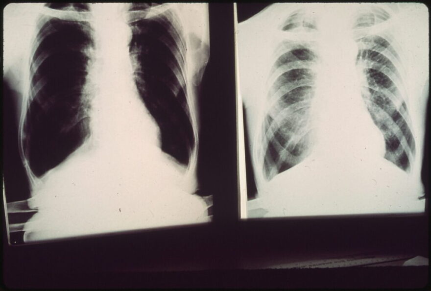 X-rays of a patient with black lung disease.