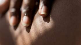 After the fires, dermatologist Shadi Kourosh noticed a sharp increase in the number of skin conditions she and her colleagues were treating. (Getty Images)