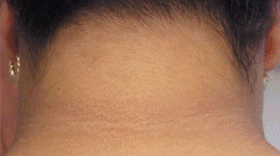 A person has a dark line on the back of their neck.