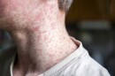 Measles viral disease, human skin covered with measles rash