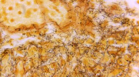 This 1966 microscope photo made available by the Centers for Disease Control and Prevention shows a tissue sample with the presence of the bacterium responsible for causing syphilis. North Carolina saw a 23% increase in syphilis cases between 2021 and 2022. (Skip Van Orden/CDC via AP)