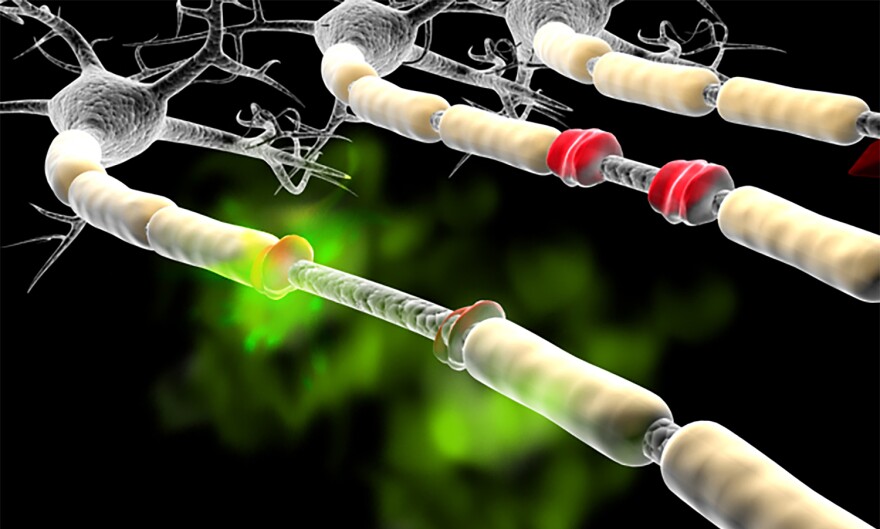 Initial tests in humans have found the substance acrolein – an excreted waste product – can accumulate in some people and damage the myelin, which surrounds the nerve cell like insulation on a copper wire.