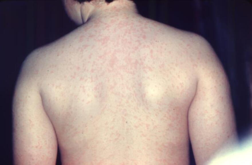 This photograph depicts a posterior view of a young patient’s back, highlighting an erythematous rash associated with measles.