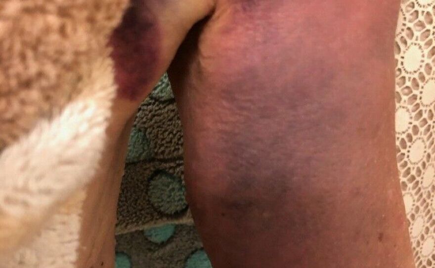 A close up photo of the back of Karen Garner's arm showing the injuries she allegedly sustained during the arrest on June 26, 2020.