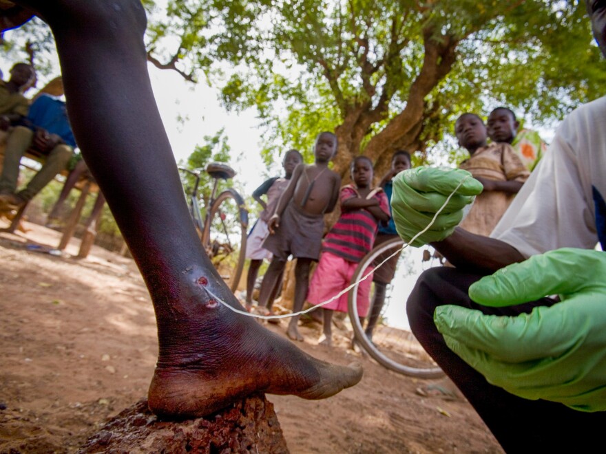 Medical worker Abaare Hussein extracts a Guinea worm from a child's leg in Savelugu Village in northern Ghana in 2007.