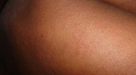 Stock image of a measles rash