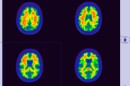 Alzheimer's disease afflicts six percent of people over age sixty five