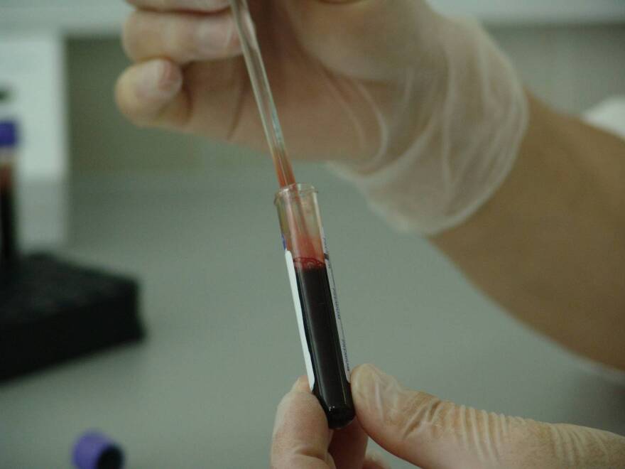 The CDC used blood samples that were collected in the field to analyze Scott County residents' HIV sequences and their "genetic distance" from each other.