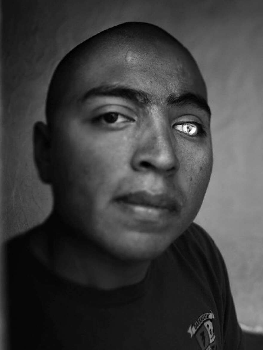 Lance Cpl. Josue Barron lost his left leg and left eye in Sangin, Afghanistan, while serving with the 3/5 Marines from Camp Pendleton, Calif. He now has a glass eye that is emblazoned with the 3/5 insignia.