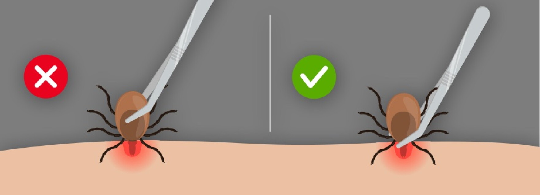 Thumbnail for Hick Removal Methods For Lepris Invaluable C Of Heute