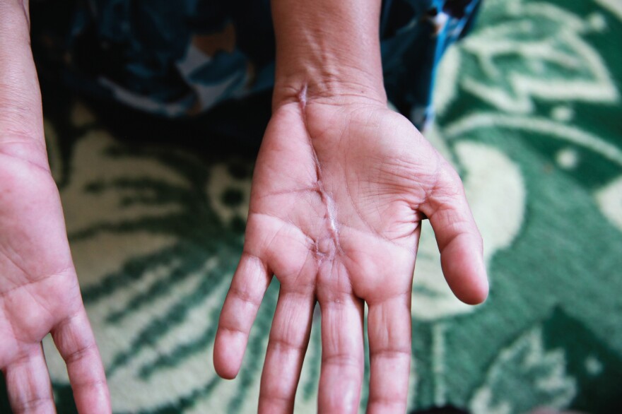 A knife attack by this woman's husband left the scar on her palm. He had accused her of interacting with men who weren't from her immediate family at their wedding. She is incarcerated at Herat Women's Prison for moral crimes.